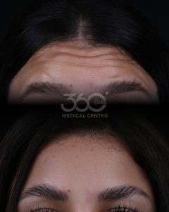 professional Botox injections to reduce facial wrinkles at 360 Cure Medical