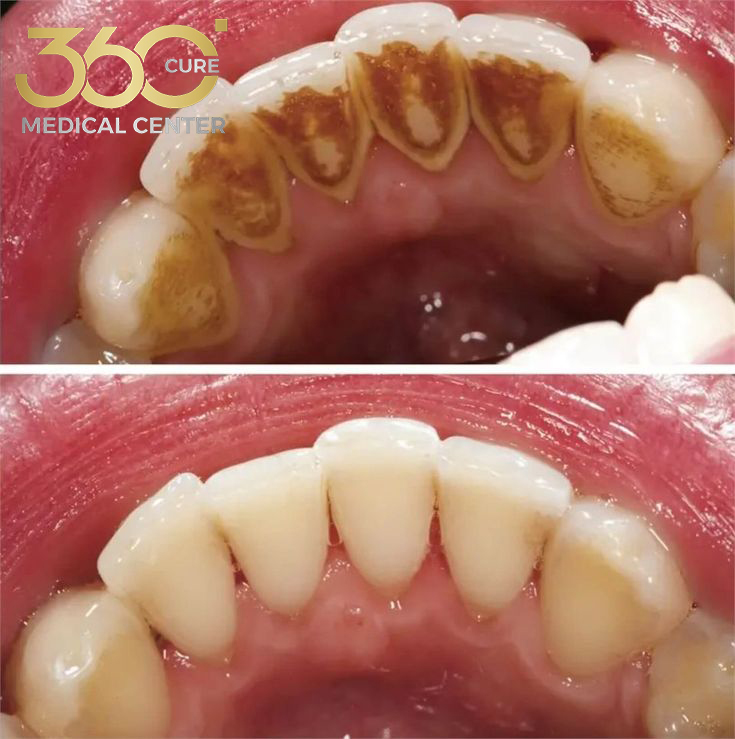 Before and after Dental Implant in Abu Dhabi – natural-looking smile transformation