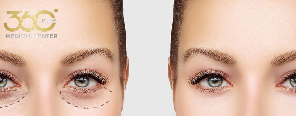 فيلر تحت العين