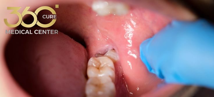 إجراء خلع ضرس العقل بأحدث التقنيات وراحة تامة في مركز 360 كيور بأبوظبي.