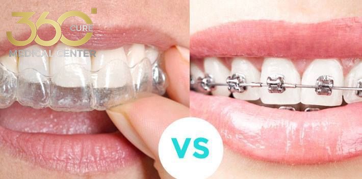 تقويم الأسنان التقليدي والشفاف