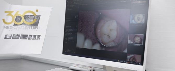 جهاز مسح داخل الفم رقمي يُستخدم لأخذ طبعات الأسنان ب تقنية CAD/CAM في مركز 360 كيور الطبي