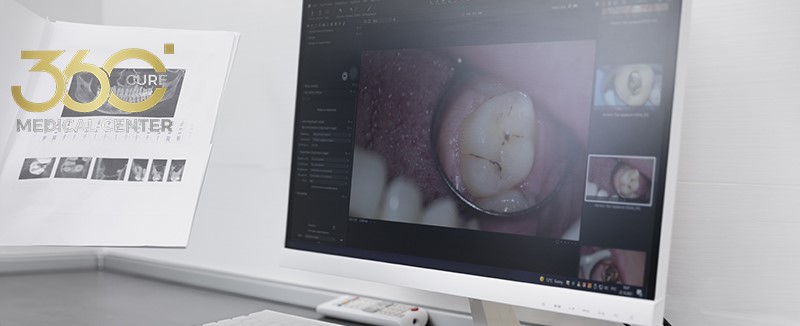 جهاز مسح داخل الفم رقمي يُستخدم لأخذ طبعات الأسنان ب تقنية CAD/CAM في مركز 360 كيور الطبي