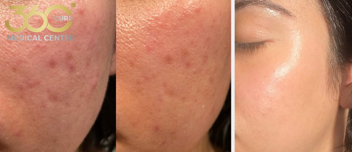 علاج حب الشباب والندبات