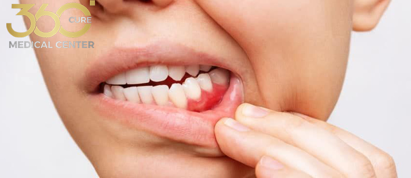 علاج أمراض اللثة