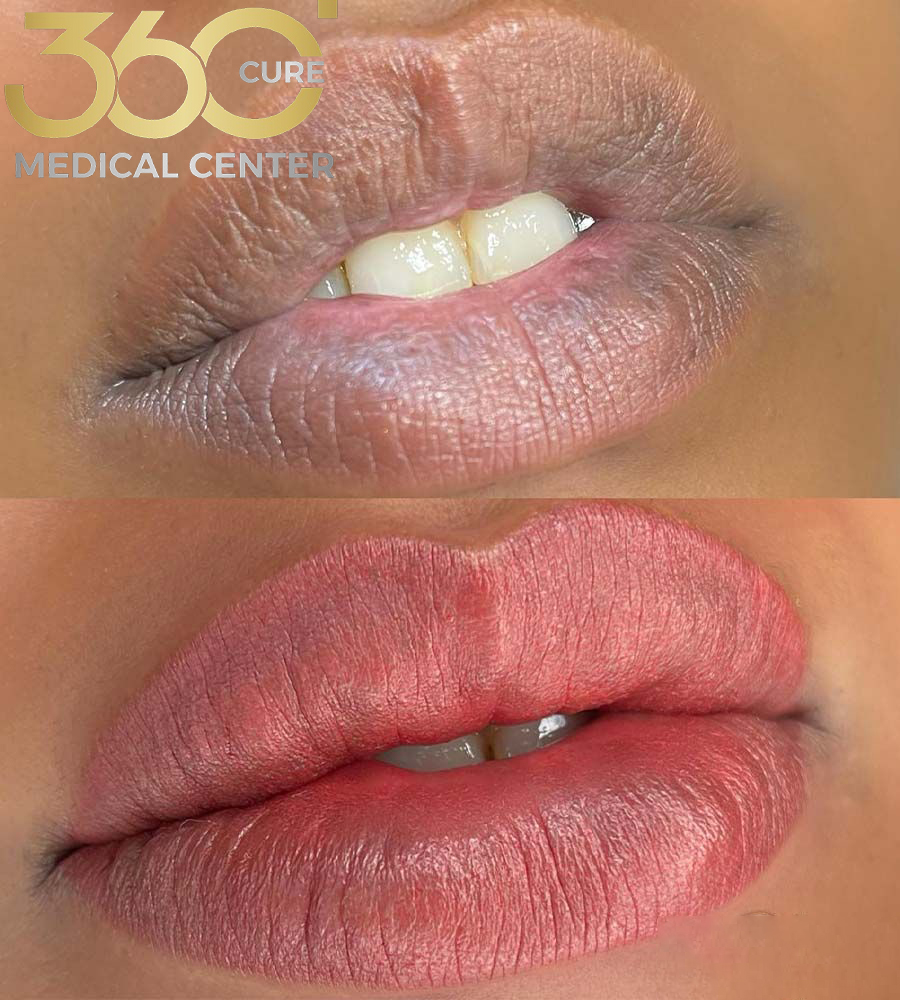 Before and after Dental Implant in Abu Dhabi – natural-looking smile transformation
