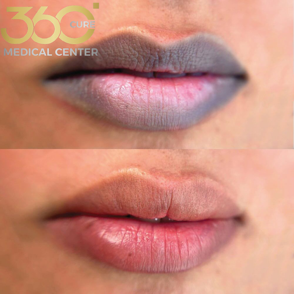 تصحيح تصبغات الشفاه