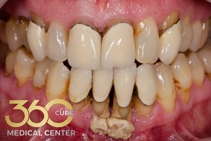 علاج أمراض اللثة