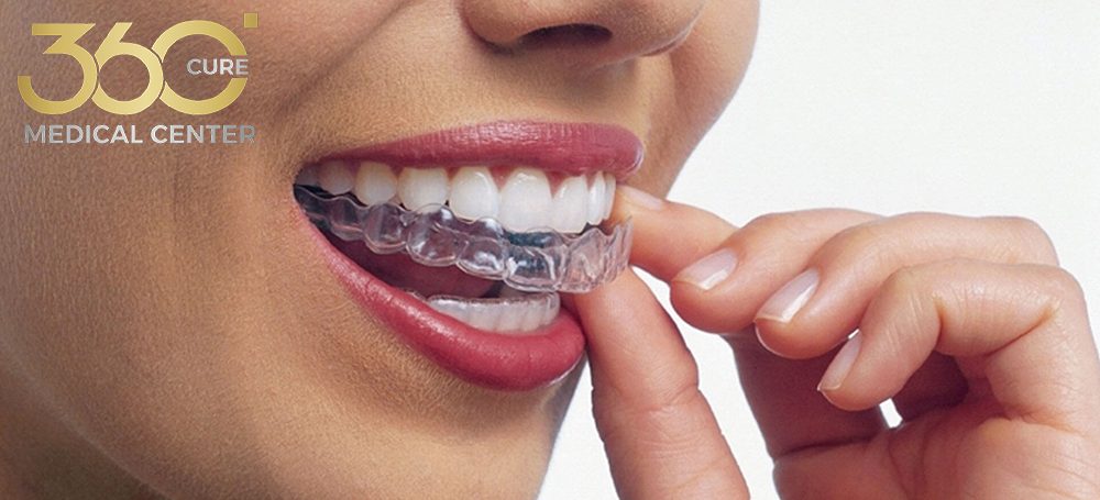 تقويم الأسنان التجميلي