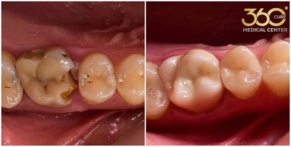 حشوة الأونلاي والحشوة التقليدية