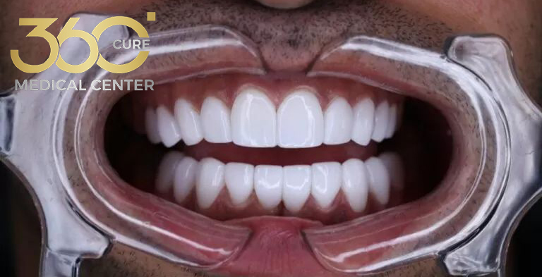 زراعة الأسنان All-on-8