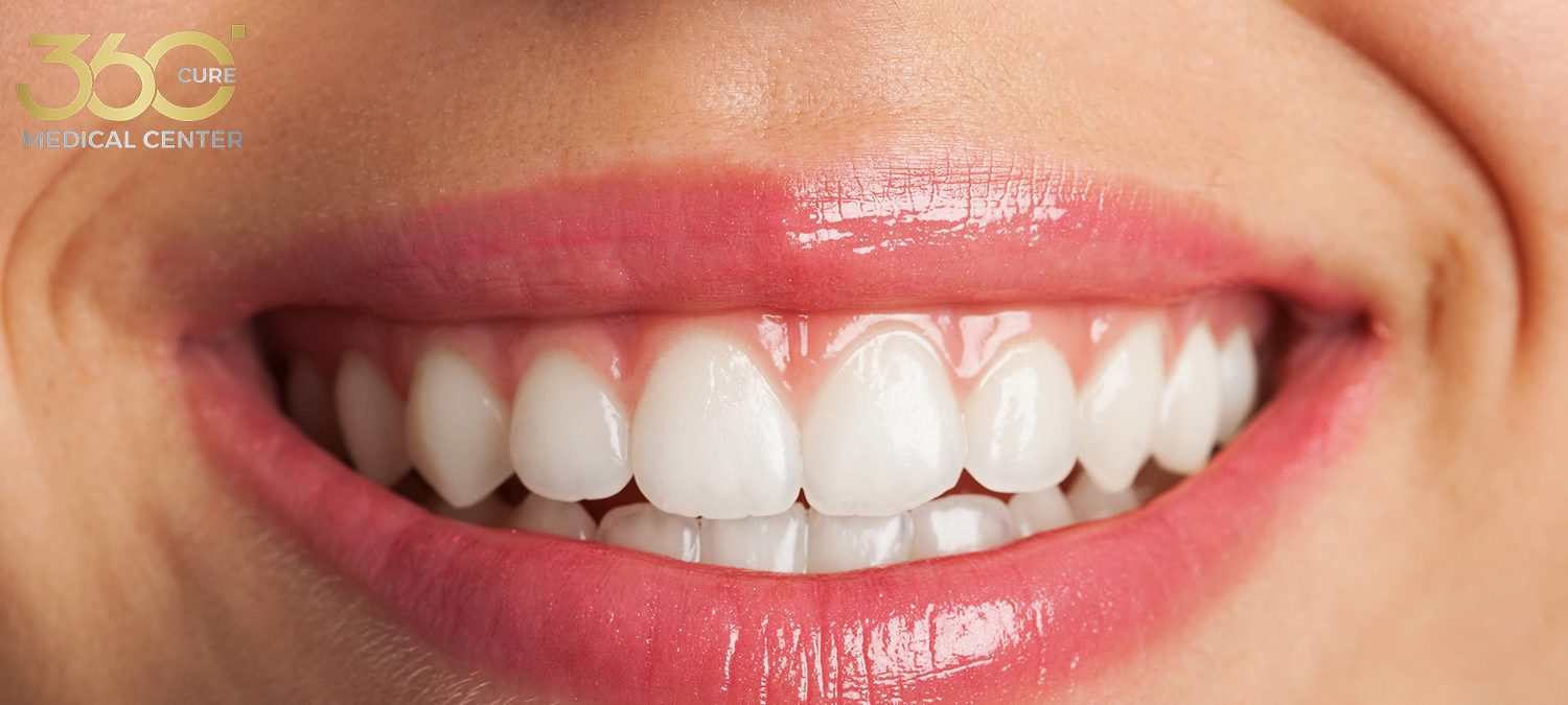 فينير الأسنان في أبو ظبي