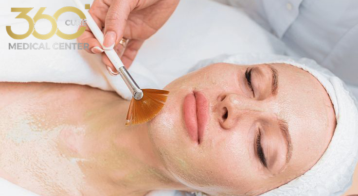 Chemical peel vs laser resurfacing
